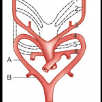 Aberrant subclavian