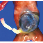 mphalocele and gastroschisis