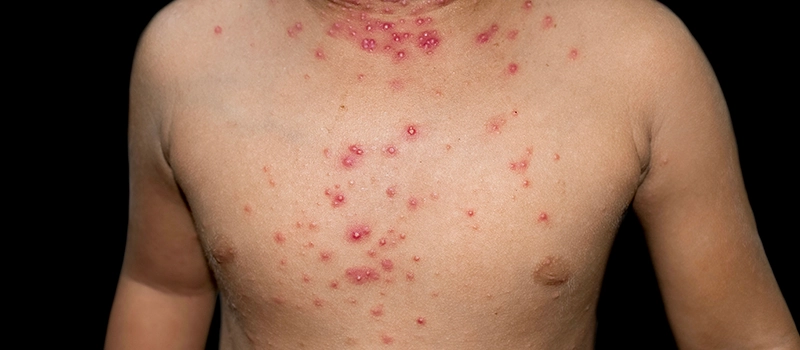 Molluscum Contagiosum