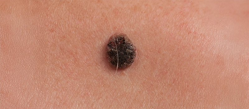 Basal vs Squamous Cell Carcinoma Signs, Types & Symptoms