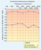 Pure tone audiometry