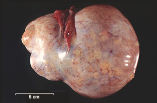 Serous cystadenocarcinoma