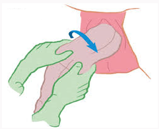 vaginal breech delivery