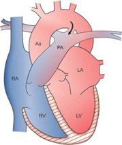 Right 4th aortic arch