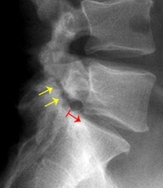 Spondylolisthesis