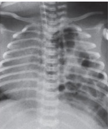 Congenital Diaphragmatic Hernia