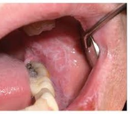 burning sensations on eating spicy food