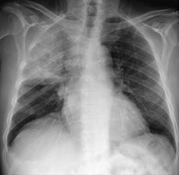Collapse of right upper lobe