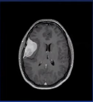 MRI of brain