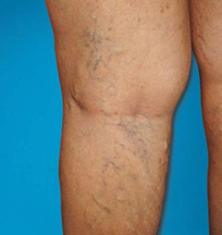 Eczema or lipodermatosclerosis may develop