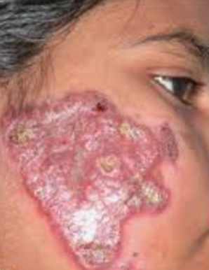 chronic granulomatous skin lesion