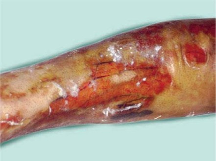A woman with deep partial-thickness burns on the lower limb