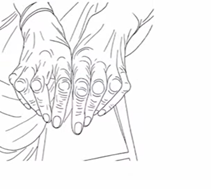 rheumatoid arthritis 