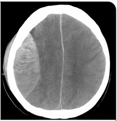 CT brain shows 