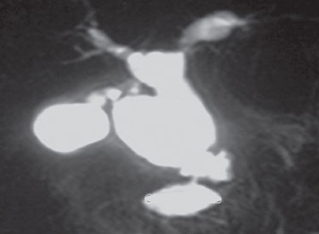 Choledochal Cyst