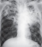 chest X-ray findings