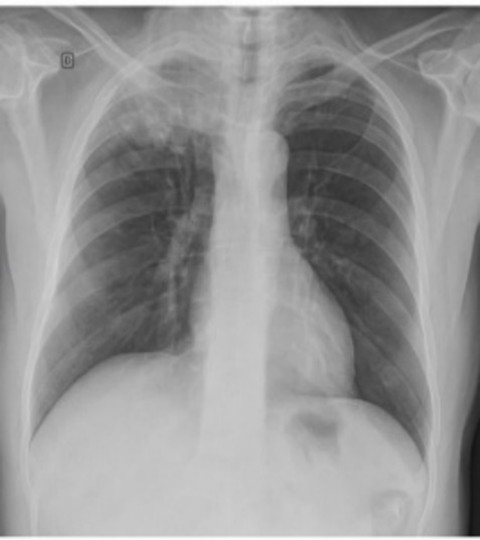 Chest X-ray