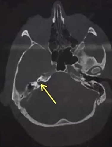 Internal auditory canal