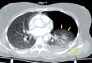 CT thorax 