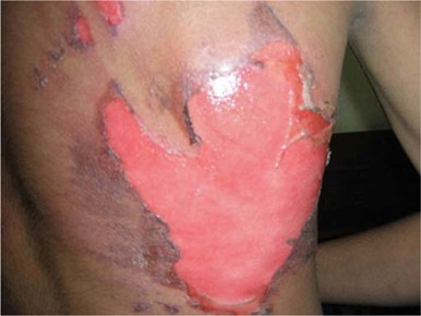 Partial thickness burns 