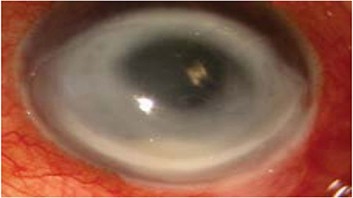 Calcofluor white stain