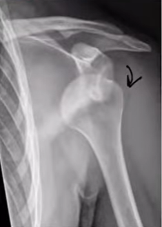 Anterior dislocation