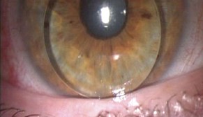 Intracameral gas injection with C3F8 for acute hydrops