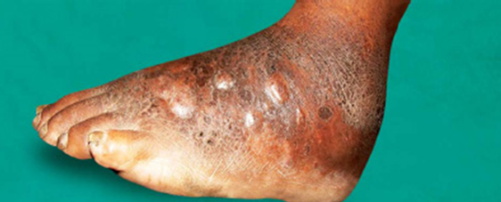 Madurella mycetomatis