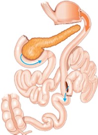 Biliopancreatic diversion