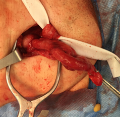 inguinal hernia 