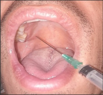 Greater palatine nerve block