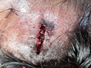Laceration