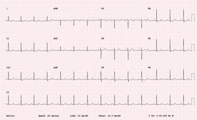 ECG reveals ST-segment elevation in leads II, III, and aVF