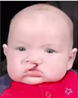 Midline cleft lip