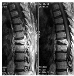 MRI spine