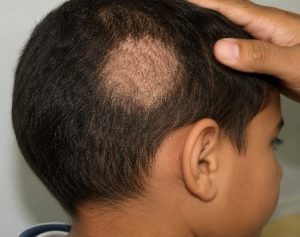 focal hair loss accompanied