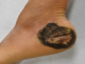 dark black lesion on the plantar surface of the foot
