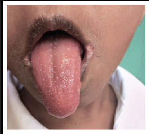 Kawasaki Disease