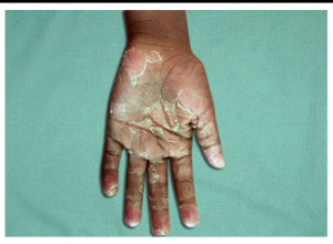 Kawasaki Disease