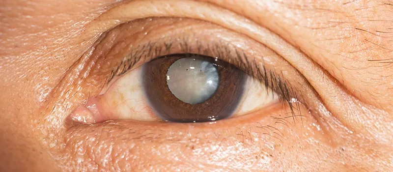 How to Manage a Senile Cataract Patient