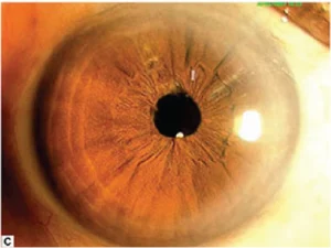 Clinical photograph post-vitreolysis