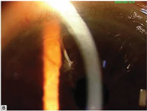 Clinical photograph shows vitreous incarceration into the wound