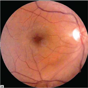 Color fundus photograph shoes postoperative cystoid macular edema